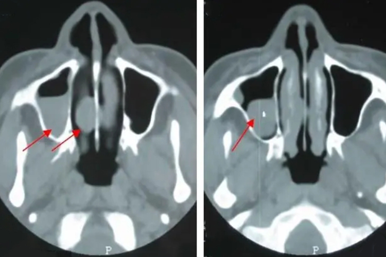 鼻窦囊肿CT图 鼻窦囊肿CT图