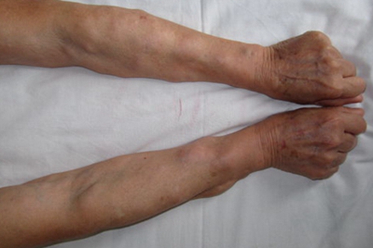 血管脂肪瘤胳膊有凸起的软疙瘩图