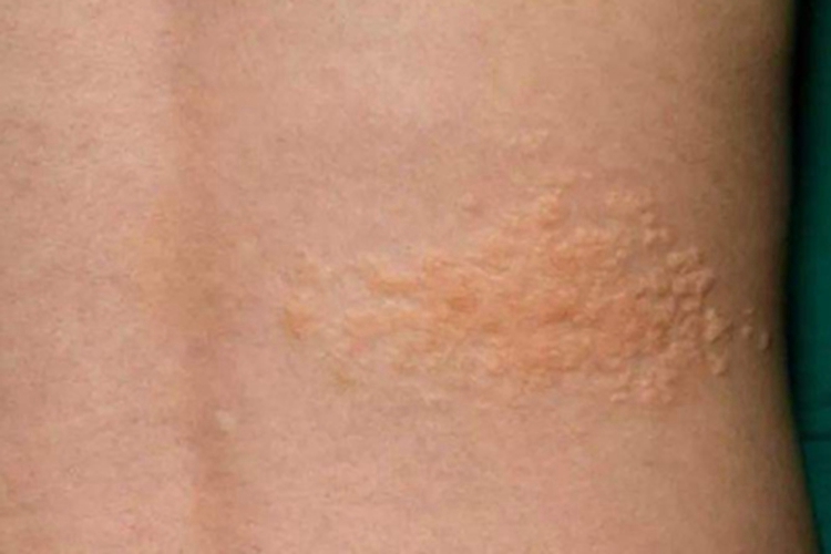 结缔组织痣腰部出现斑图 结缔组织痣腰部出现斑图