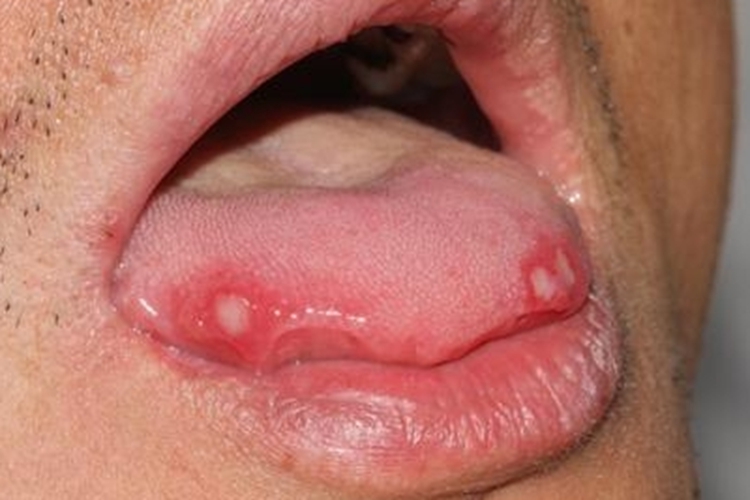 舌头溃疡白色图片