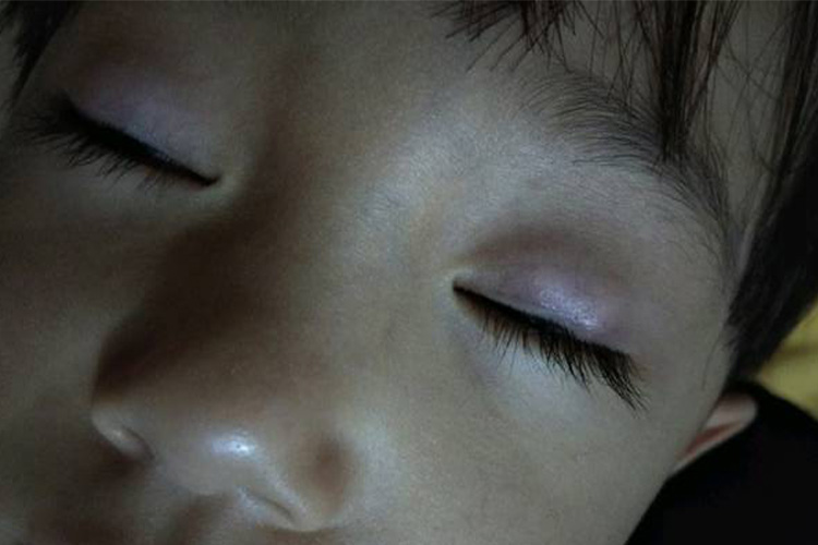 结膜处紫红色病灶图