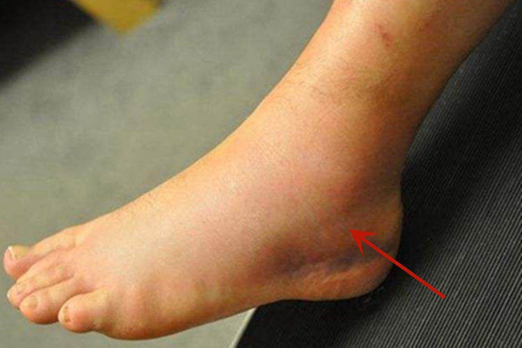 中度扭伤左脚脚踝肿了图