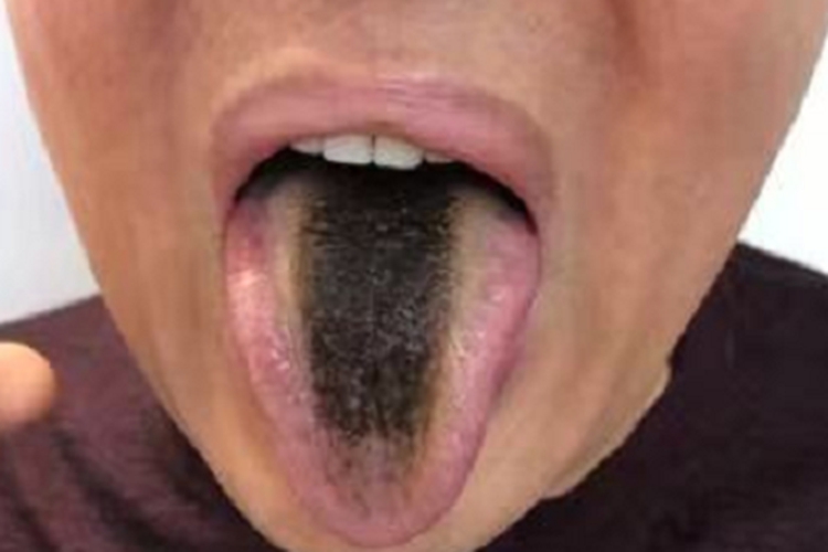 黑舌舌头上有一片变黑图