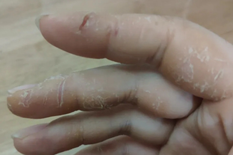 皲裂性湿疹手指裂个口子图