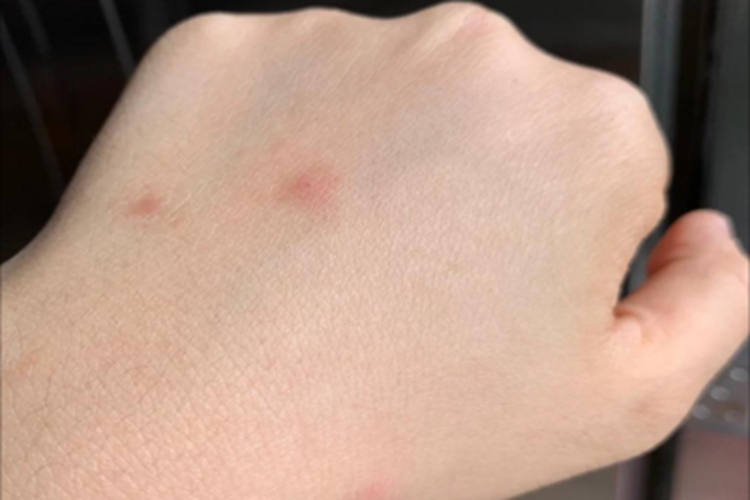 虫咬皮炎手背红斑图