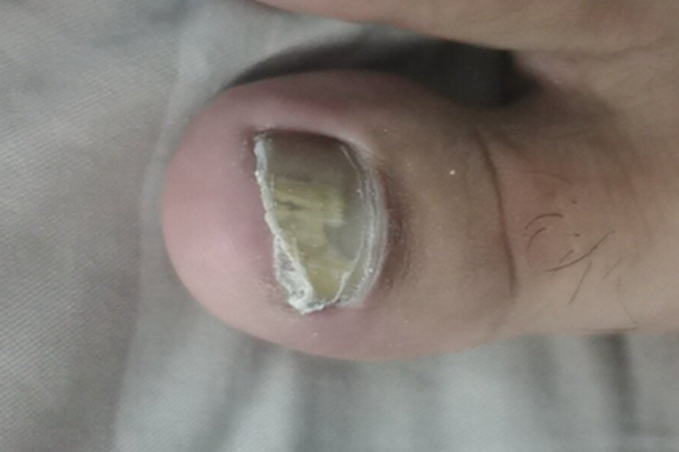 全甲损毁型甲真菌病脚趾甲发黄图 全甲损毁型甲真菌病脚趾甲发黄图