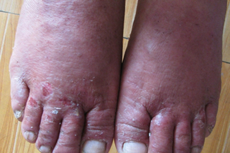 亚急性湿疹脚背红肿糜烂图