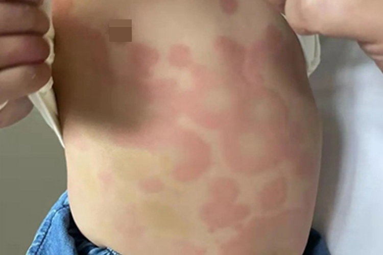 荨麻疹性血管炎腹部红斑图