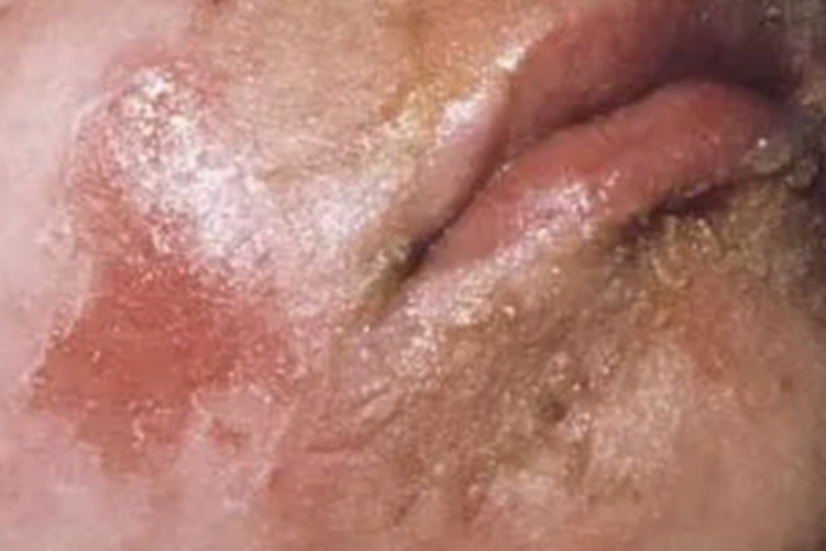 急性期口周湿疹渗液图 急性期口周湿疹渗液图