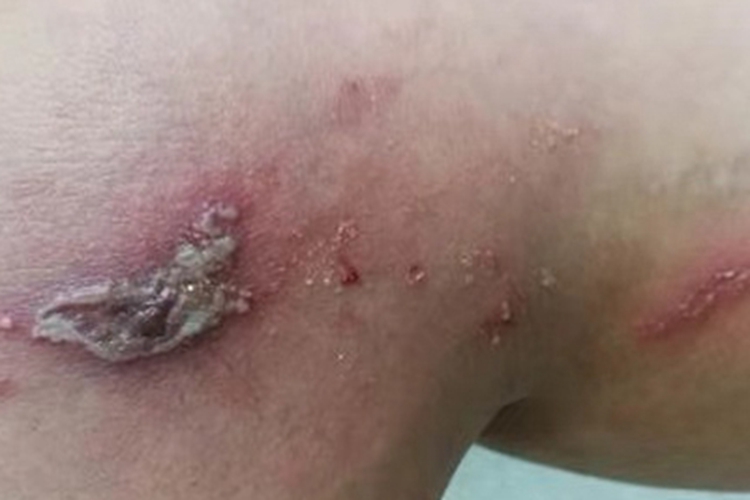 钩蚴性皮炎大腿结痂图 钩蚴性皮炎大腿结痂图