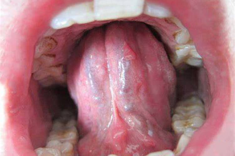 口腔内菜花状小疙瘩图