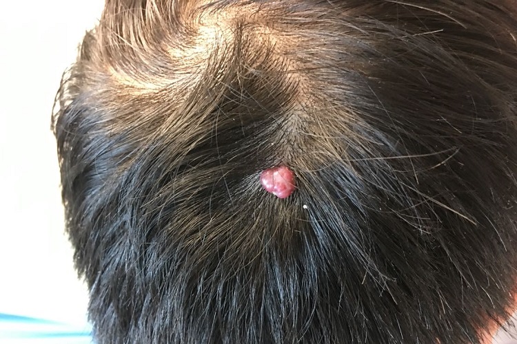 骨嗜酸性粒细胞肉芽肿头皮结节图 骨嗜酸性粒细胞肉芽肿头皮结节图