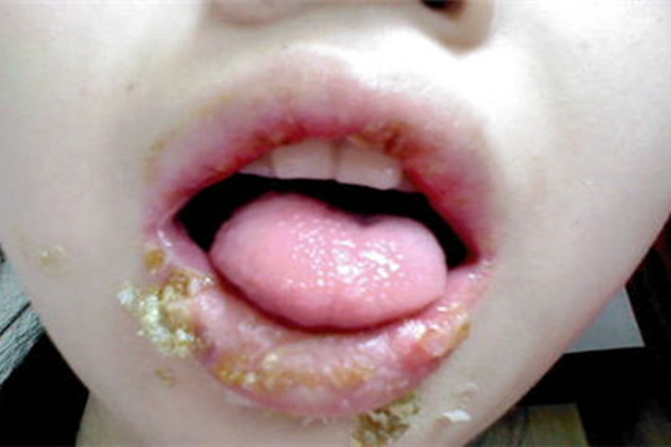 急性光化性唇炎图