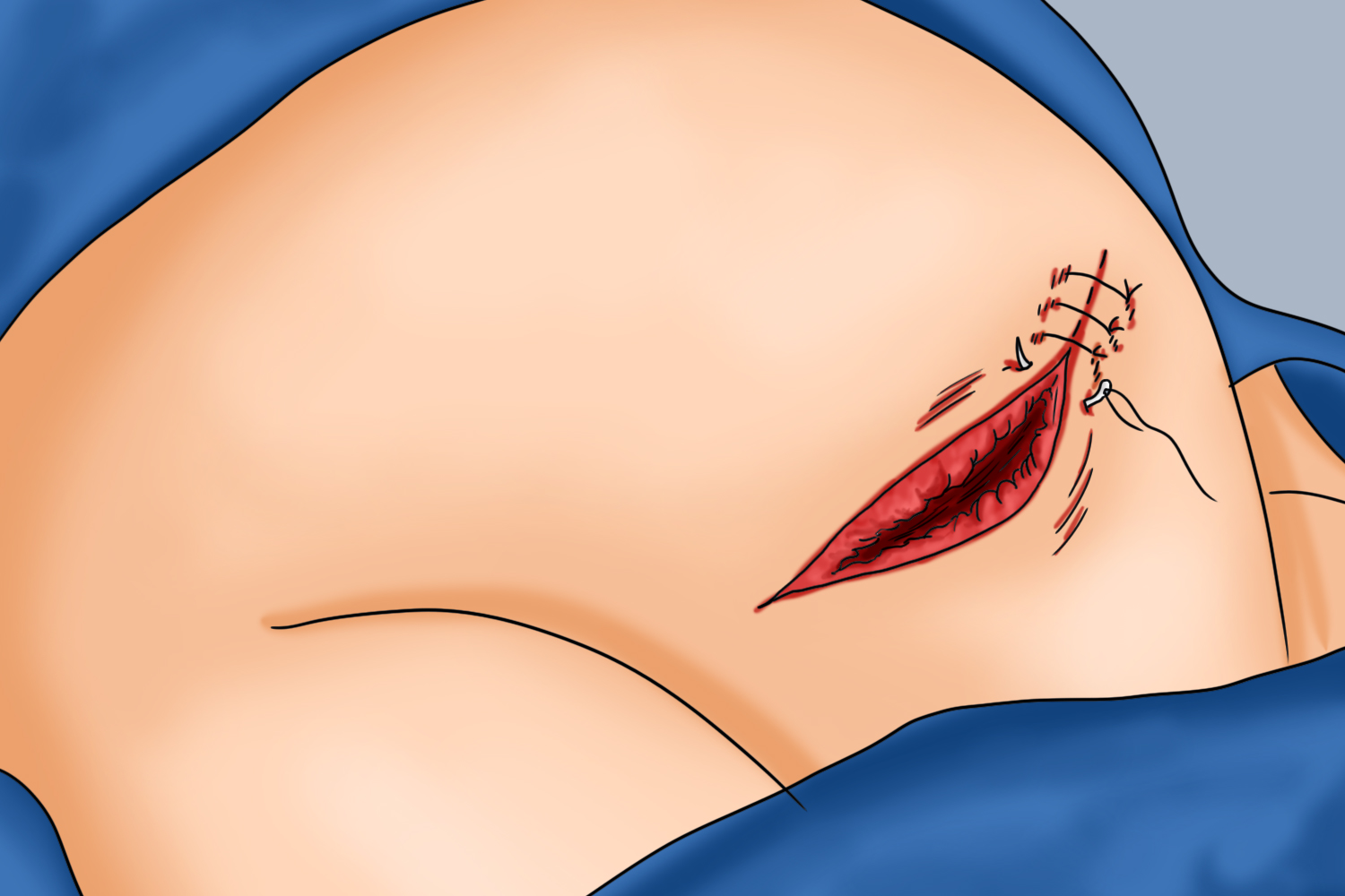 剖腹产单纯缝合法图