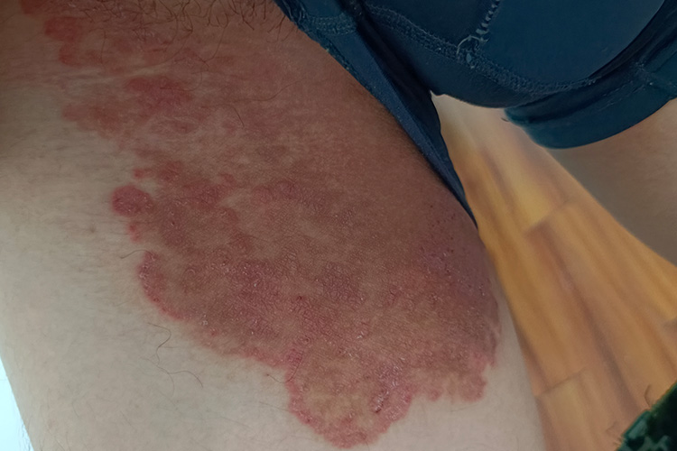 股上部内侧红斑图