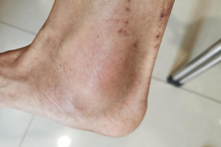 痛风性关节炎脚踝红肿图 痛风性关节炎脚踝红肿图