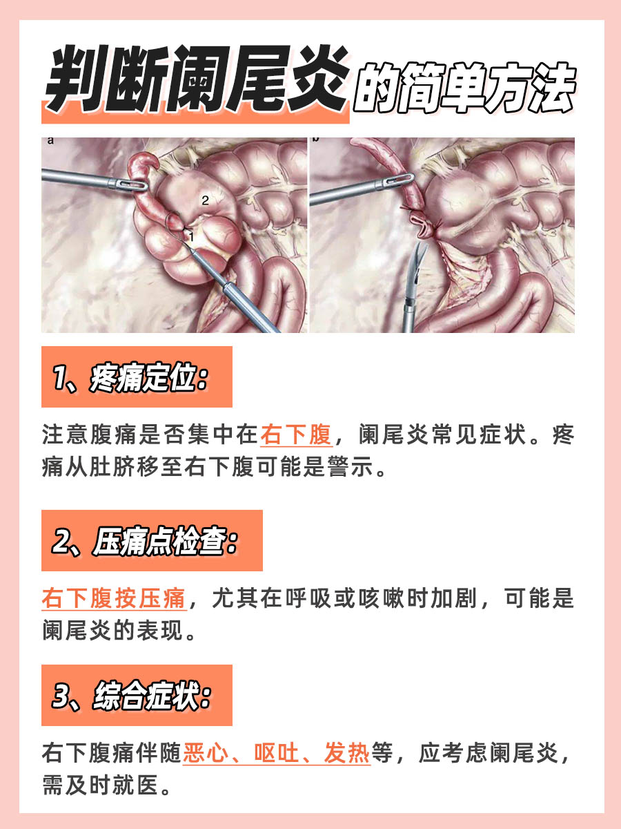 快速自查:如何初步判断是否阑尾炎