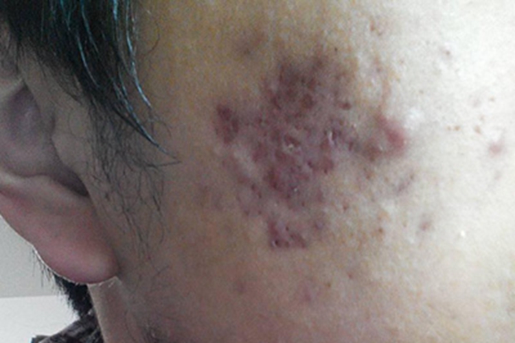 痤疮右脸紫斑图 痤疮右脸紫斑图