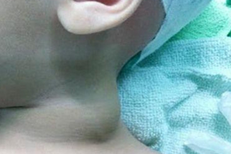 海绵状淋巴管瘤侧颈肿块图