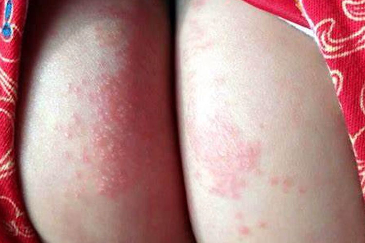 新生儿尿布皮炎丘疹图 新生儿尿布皮炎丘疹图