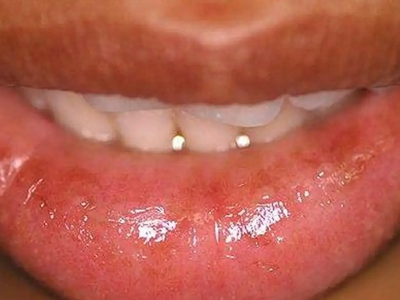 接触性唇炎下嘴唇有红斑图.jpg