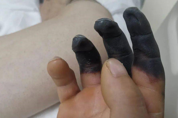 手指动脉血栓图