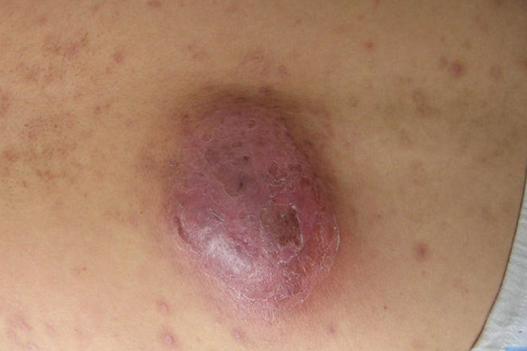 弥漫性炎性硬块图