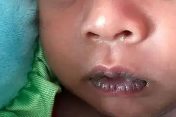 先天性心脏病紫绀图