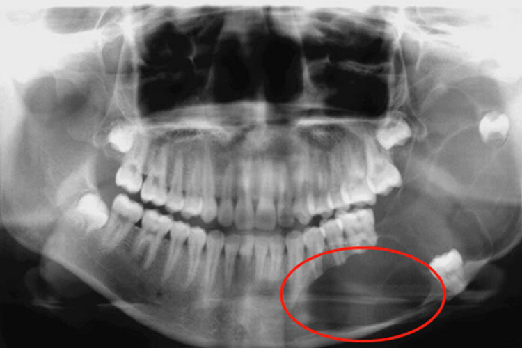 左下颌成釉细胞瘤图