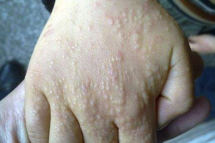 洗衣液过敏慢性症状图