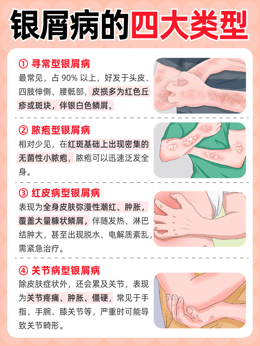 银屑病是什么病，3分钟搞懂它的真面目