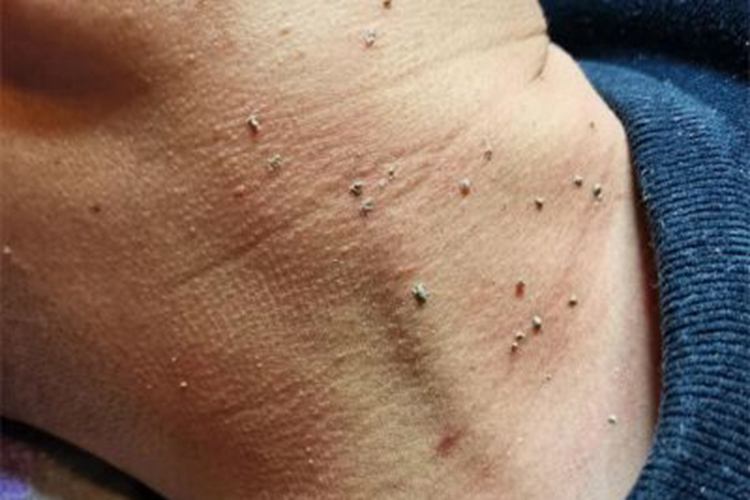 寻常疣颈部症状图 寻常疣颈部症状图