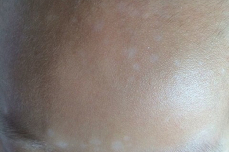 花斑癣早期症状图