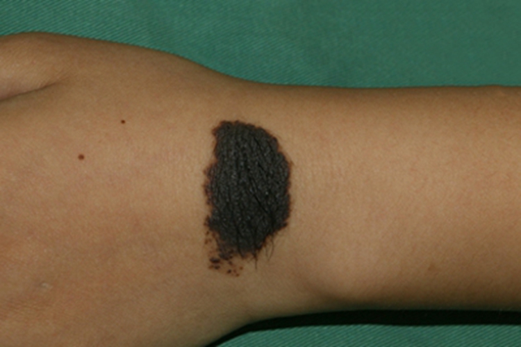 复合痣手腕黑斑图 复合痣手腕黑斑图