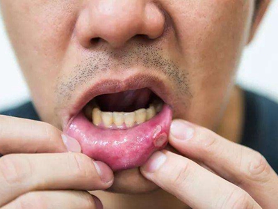 过敏性接触性口炎的症状和图片 - 有来医生