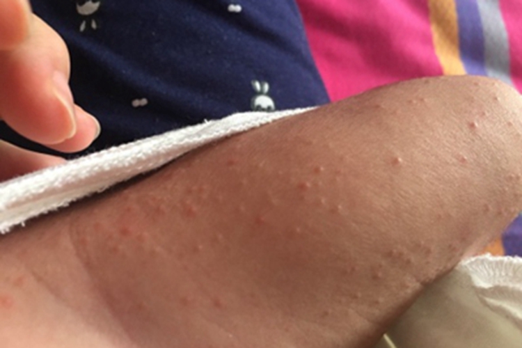 特应性皮炎大腿丘疹图