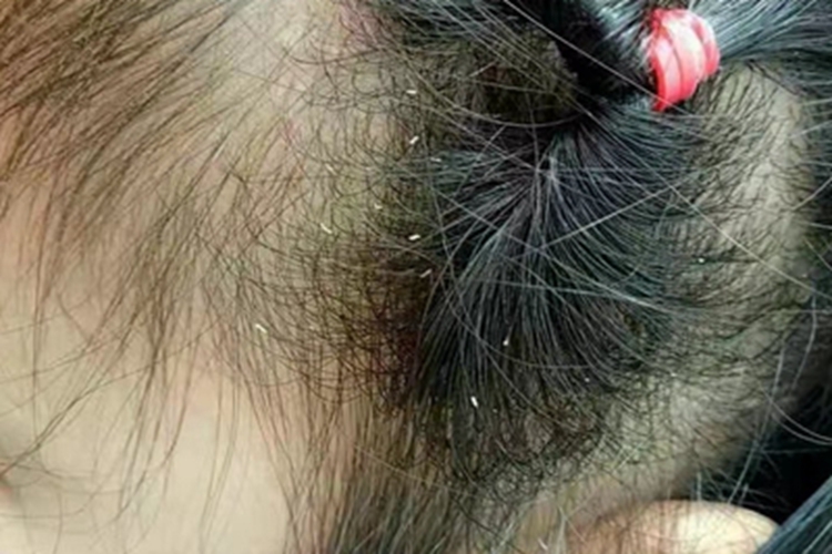 蠕形螨病头部白点图