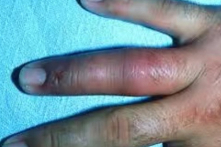 局限型类丹毒皮肤发紫图 局限型类丹毒皮肤发紫图