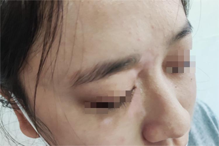 节段型白癜风面部斑图