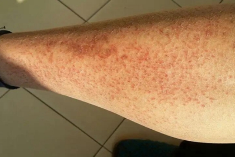 干性湿疹小腿结痂脱屑图