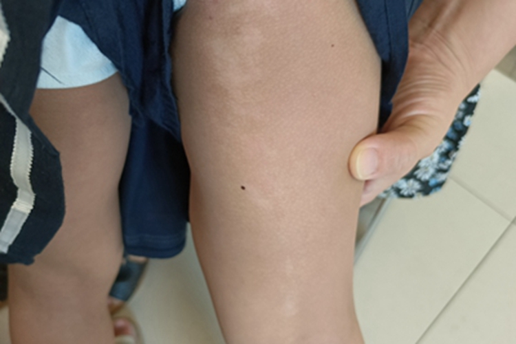 线状苔藓腿白斑图