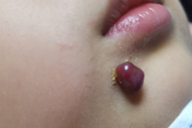 化脓性肉芽肿面部结节图 化脓性肉芽肿面部结节图