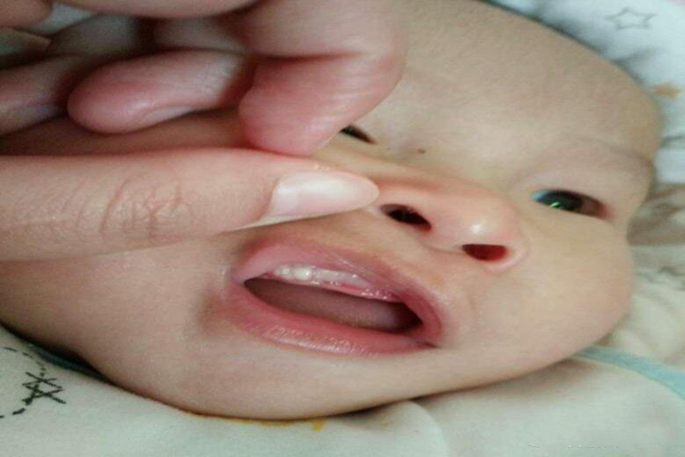 上牙龈马牙图 上牙龈马牙图