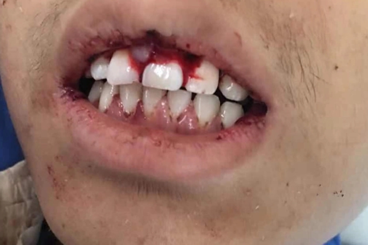 白血病牙龈血凝块增生图