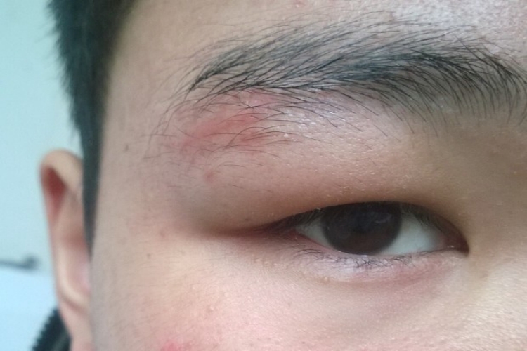 瘢痕疙瘩眉毛有斑块样瘢痕图 瘢痕疙瘩眉毛有斑块样瘢痕图