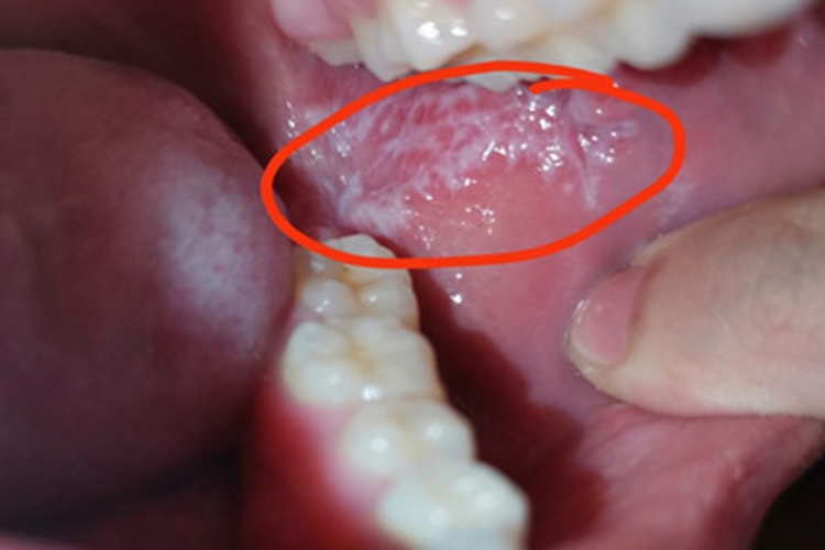 扁平苔藓口腔里面有网状斑块图 扁平苔藓口腔里面有网状斑块图