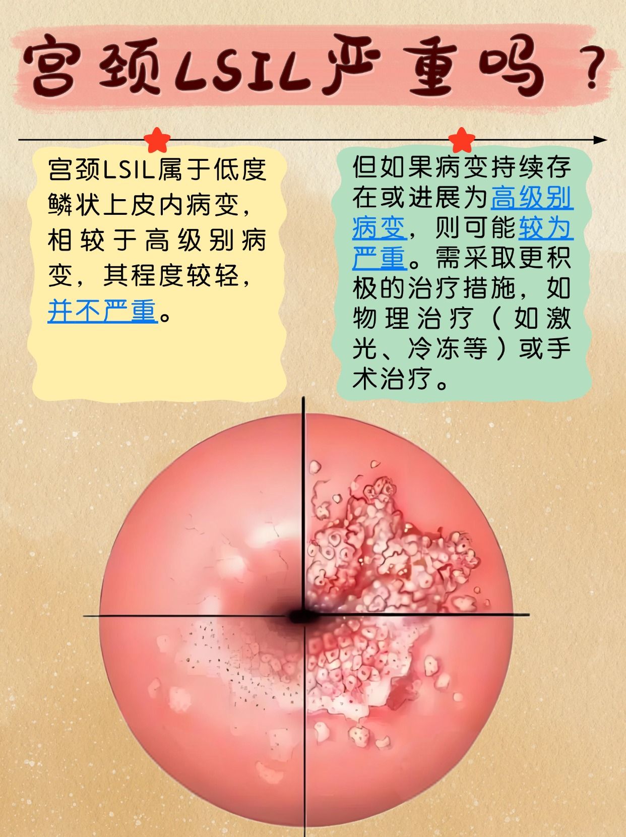 宫颈LSIL：是危机还是虚惊一场？严重性分析