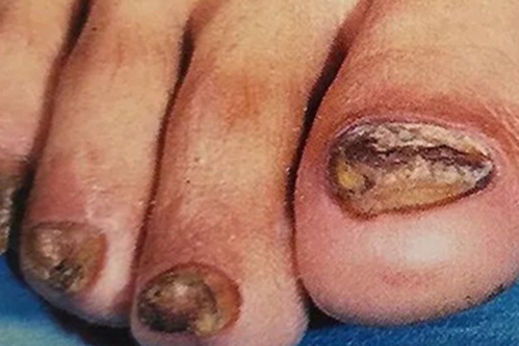 先天性厚甲症脚趾甲变黄变厚图