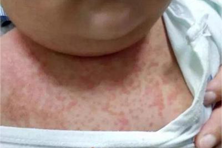 普通型猩红热前胸有密集小丘疹图