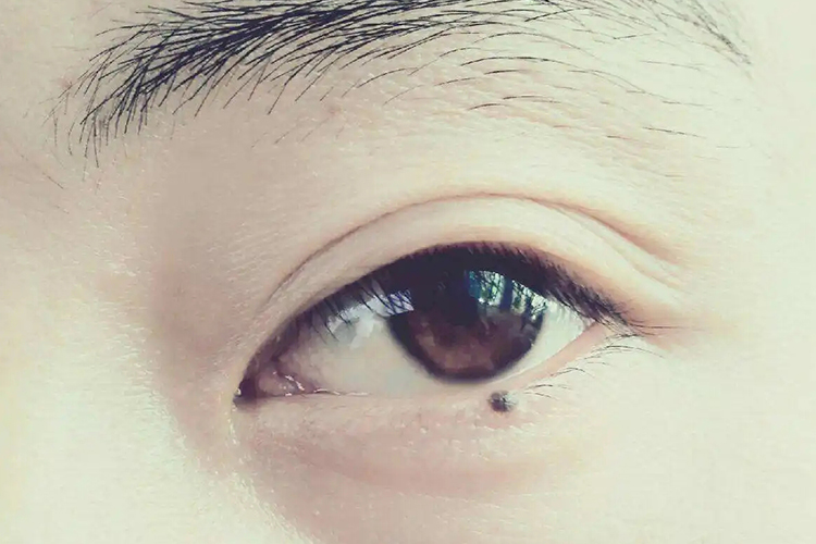 眼皮长色素痣图